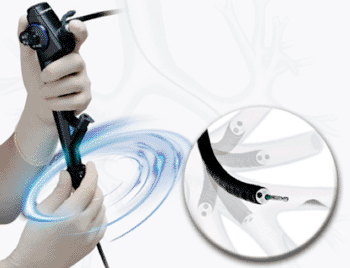 Image: The Olympus BF-190 Bronchoscope (Photo courtesy of Olympus Corporation of the Americas).